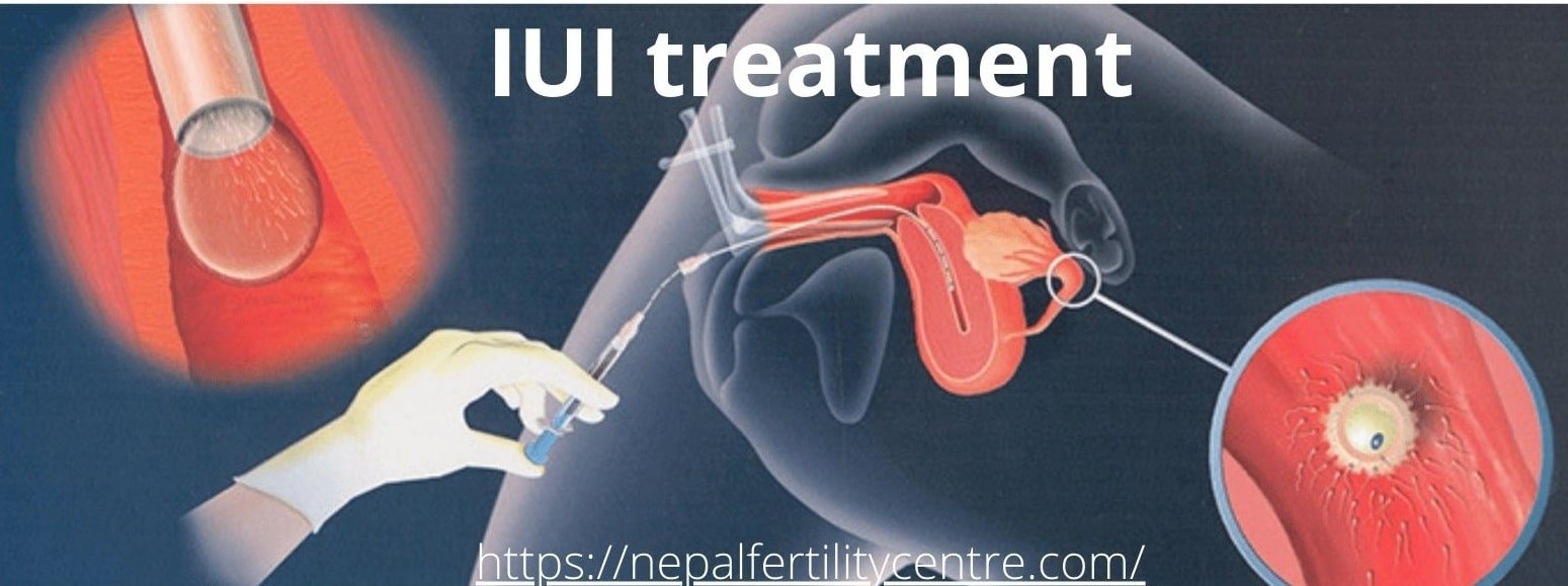 How much does IUI treatment cost in Nepal